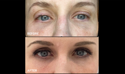 Tear Trough Rejuvenation Before After Mississauga Oakville copy